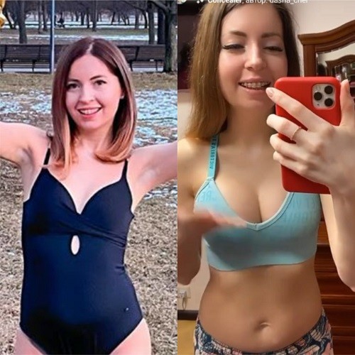 Фото груди Екатерины Диденко до и после пластики