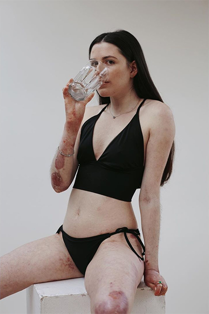 Студентка с редким заболеванием кожи снялась в купальнике для журнала Vogue